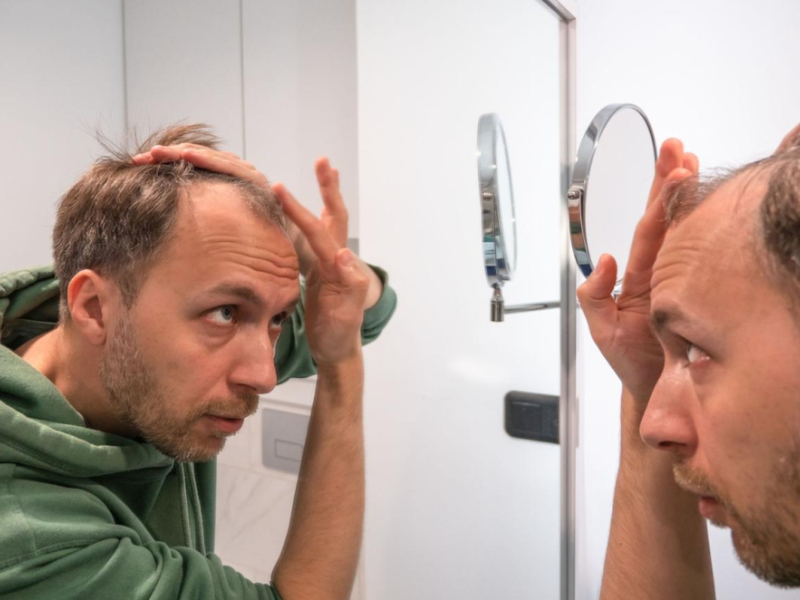 Préserver ses cheveux naturels avec une prothèse capillaire : un investissement 